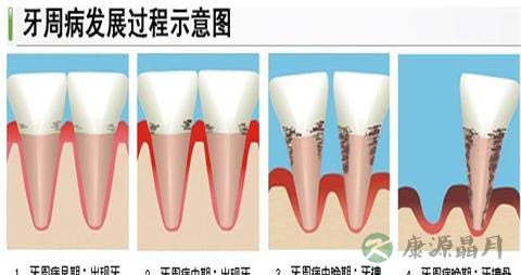 牙周手术后注意事项