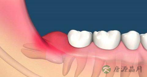 发炎期间能拔智齿吗