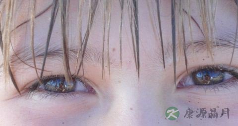 眼睛红痒怎么办