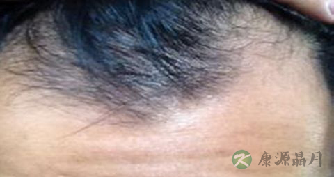 油脂性脱发怎样治疗