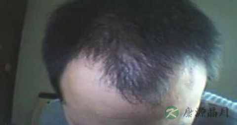 有什么方法治疗脱发