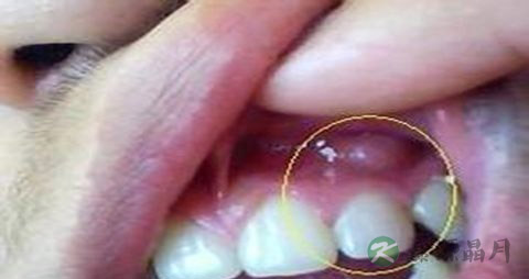 牙龈肿了吃什么