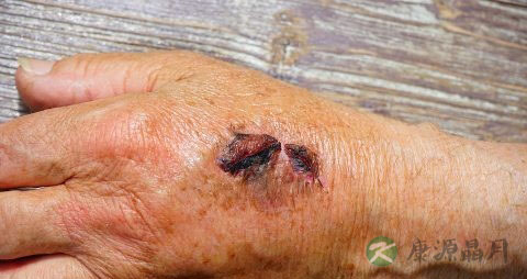 伤口愈合吃什么