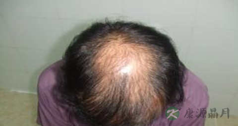 脱发秃顶的原因