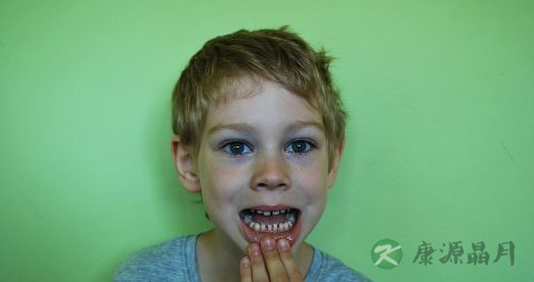 门牙掉了怎么办