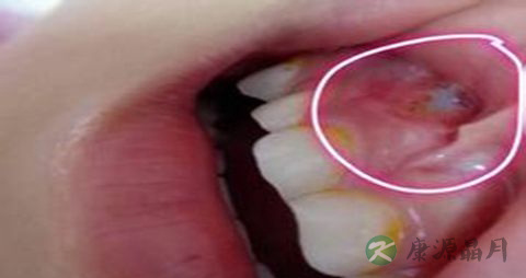 吃什么有助于牙龈