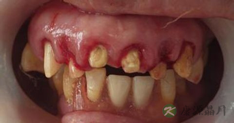 牙龈萎缩吃什么