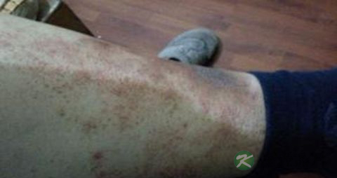 腿上有血栓吃什么