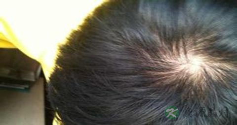 头上脱发怎么回事