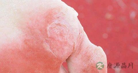 脚趾缝烂怎么办