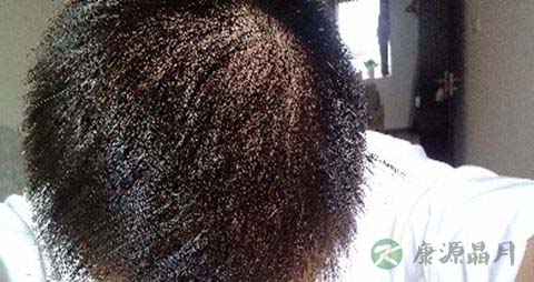 怎么治疗油脂性脱发