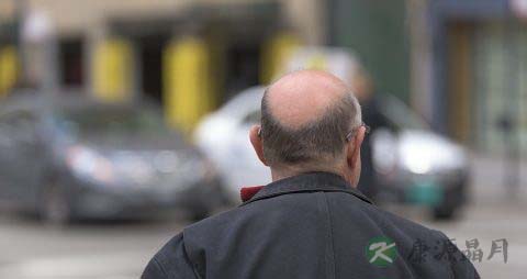 斑秃治疗的方法