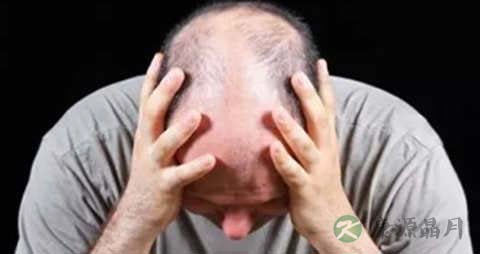 雄性激素源性脱发治疗