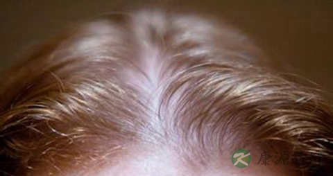 头发稀少脱发怎么办