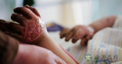 烧伤级别有哪些