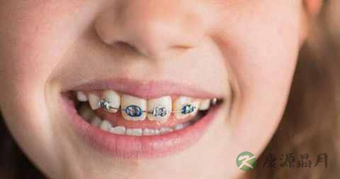 矫正牙齿的饮食