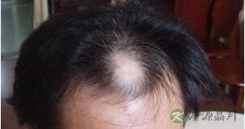 头上脱发怎么办