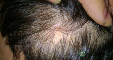 突然脱发严重什么原因