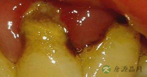 吃什么食物对牙龈好