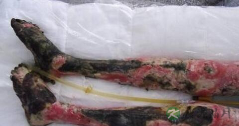 烧伤级别有哪些