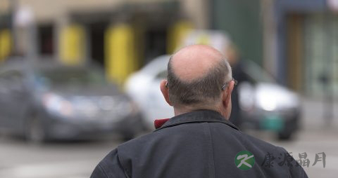 斑秃的症状表现