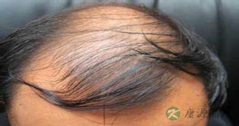 遗传脱发如何治疗