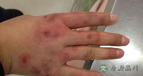 冻伤疤痕怎么去除