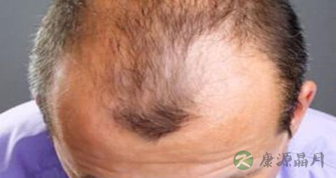 怎么治疗油脂性脱发