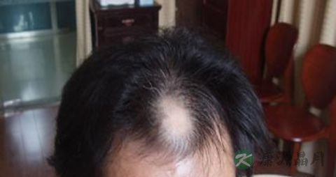 脂溢性脱发用什么洗发