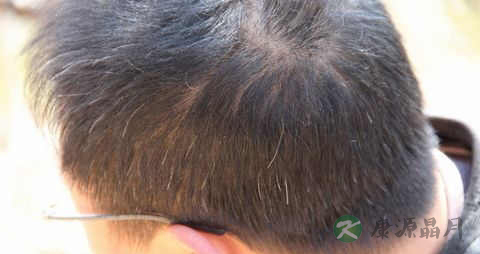 斑秃有什么症状