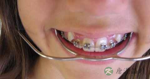 矫正牙齿的饮食