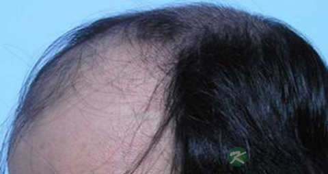 遗传性脱发的特征