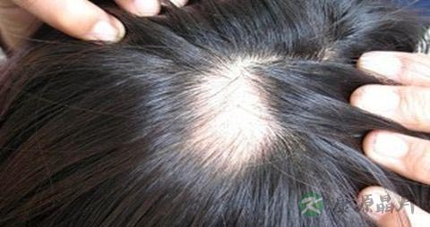 头顶脱发是什么原因