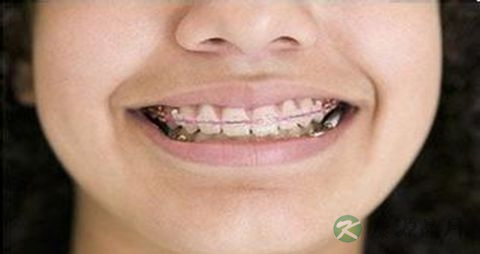 牙齿矫正后能吃什么