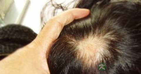 如何治疗油脂性脱发