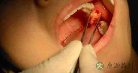 拔完牙齿吃什么好