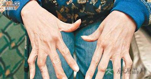 风湿吃什么食物好