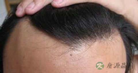 头发稀少脱发怎么办