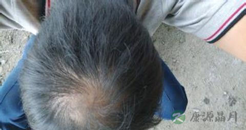 如何治疗头顶脱发