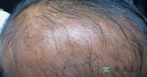 怎么治疗油性脱发