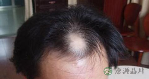 脱发是由什么引起的