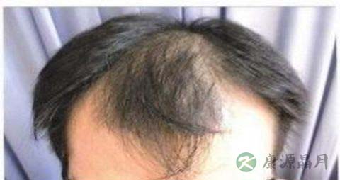 肾虚脱发怎么治疗