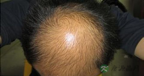 头发掉吃什么好