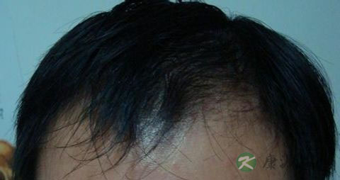 肾虚脱发用什么洗发水