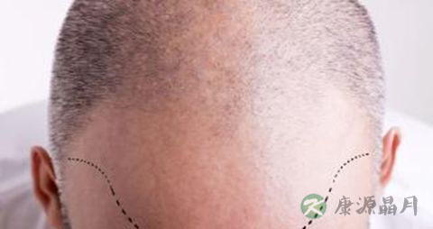 头顶斑秃怎么办