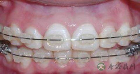 吃什么食物对牙龈好