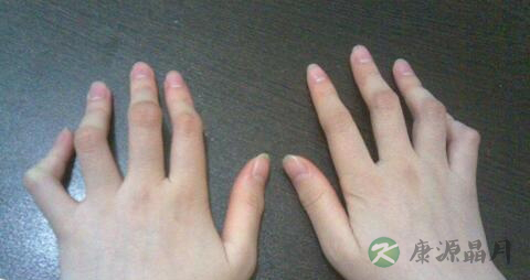 类风湿什么不能吃