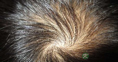 男人脱发怎么治疗