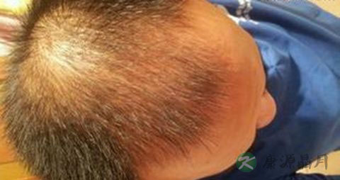 治疗男性脱发的药物