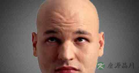 遗传性脱发能治吗